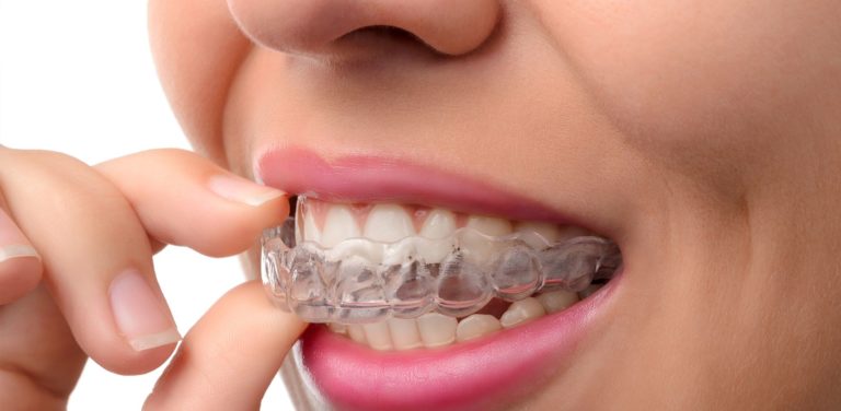 Invisalign For Underbite Can Invisalign Fix Underbite