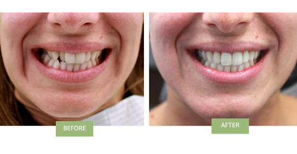 Invisalign NYC - Cost & Info| Invisalign Dentists In NYC