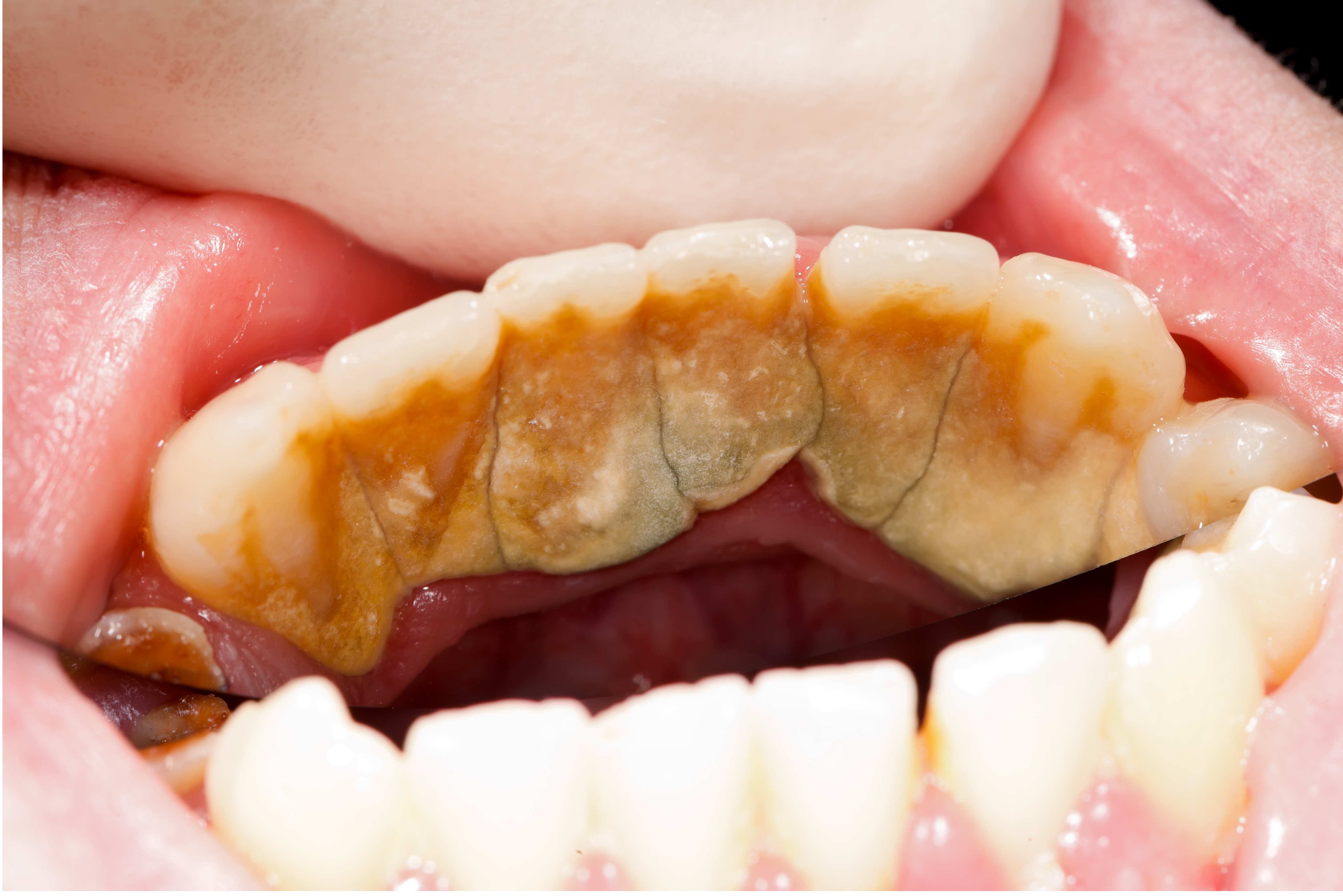 Plaque on Teeth Causes and How to Remove Plaque Buildup
