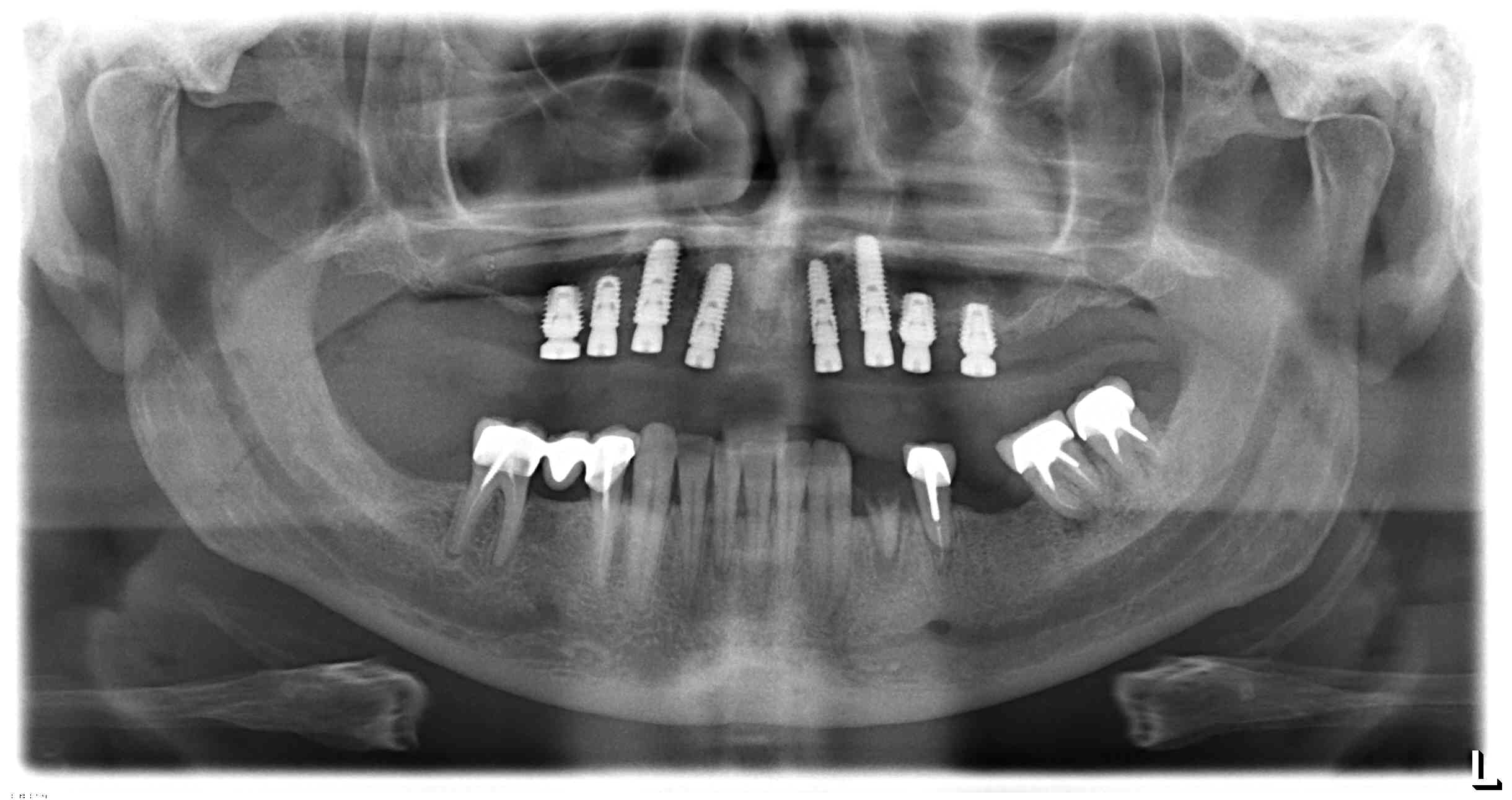 Dental Implants Center Midtown New York -POst-op Panoramic Showing Full Upper Dental Implant