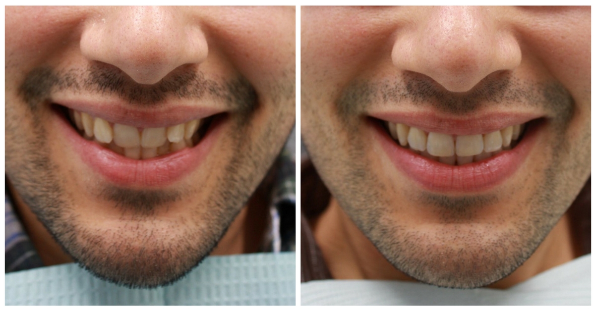 invisalign braces nyc teeth before crooked york