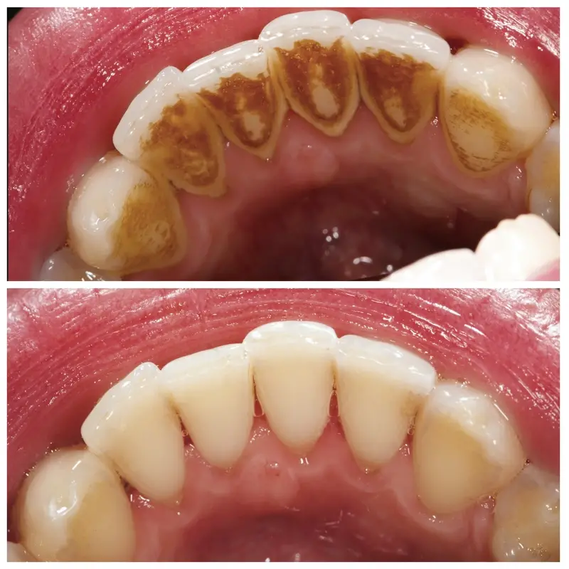 before and after a teeth cleaning