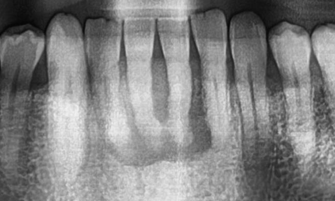 Oral Surgery NYC - front teeth with sever bone loss