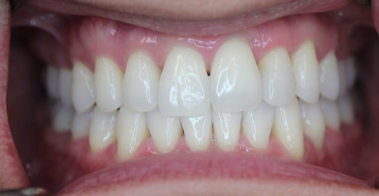 how much is zoom whitening