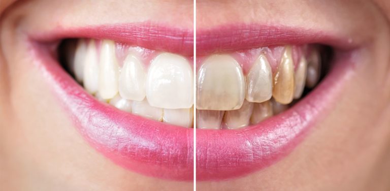 laser-teeth-whitening-swindon-ambience-dental-practice