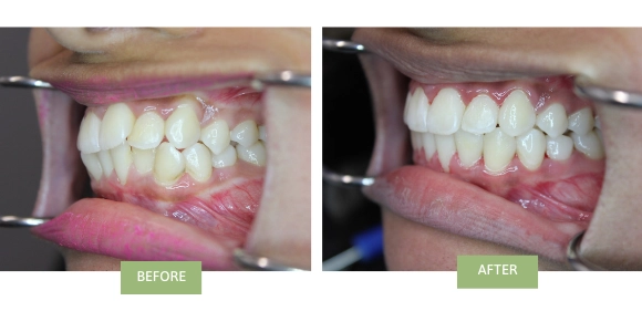 Before and after images from someone who wore clear aligners