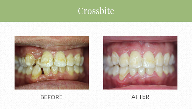 A before-and-after image showing how Invisalign can fix crossbites