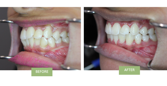 crossbite Invisalign before and after images