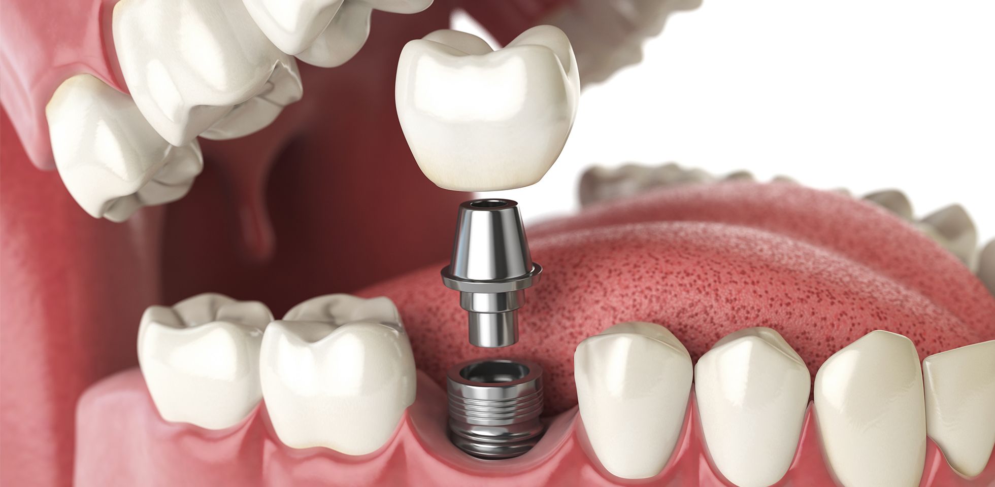 An image detailing the components of implant dentistry, including the implant and its corresponding screw