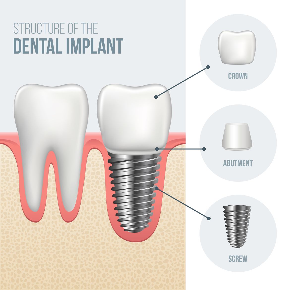 A dental implant crown abutment