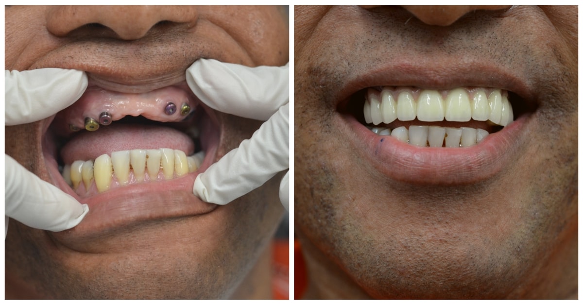 A before-and-after image of implant crowns in NYC