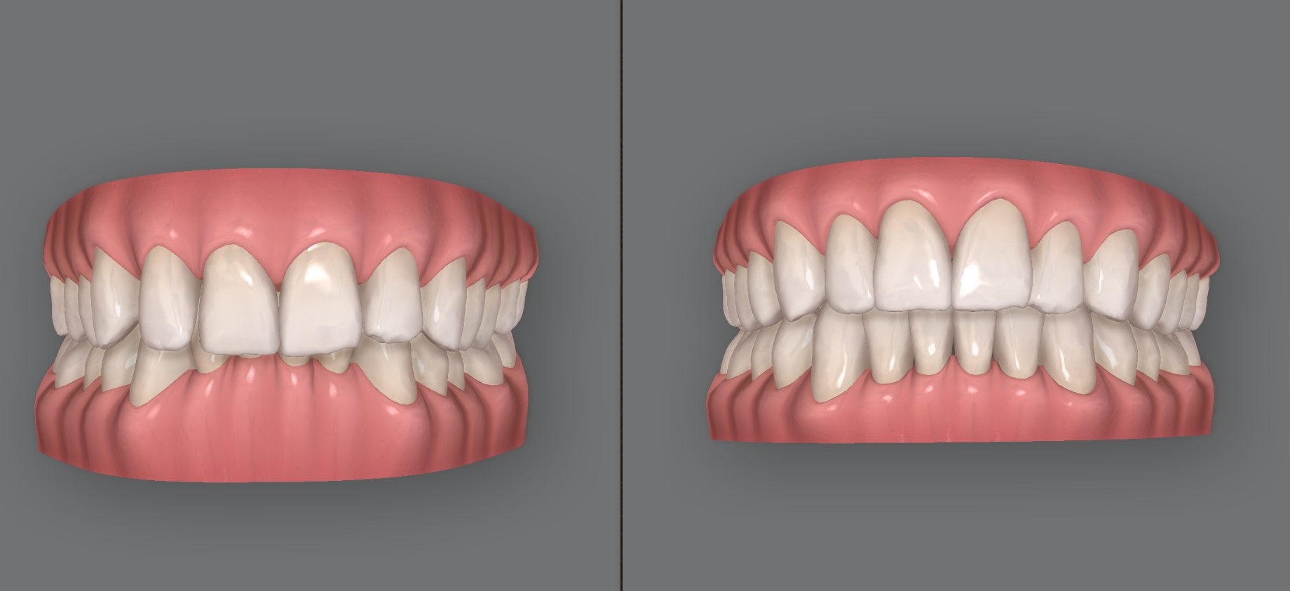 Invisalign for overbite