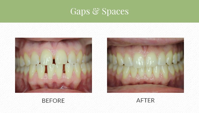 Before and after Invisalign for gaps and spaces