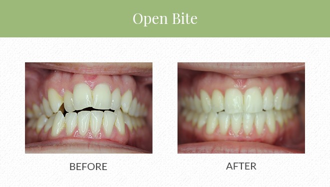 Before and after Invisalign for an open bite