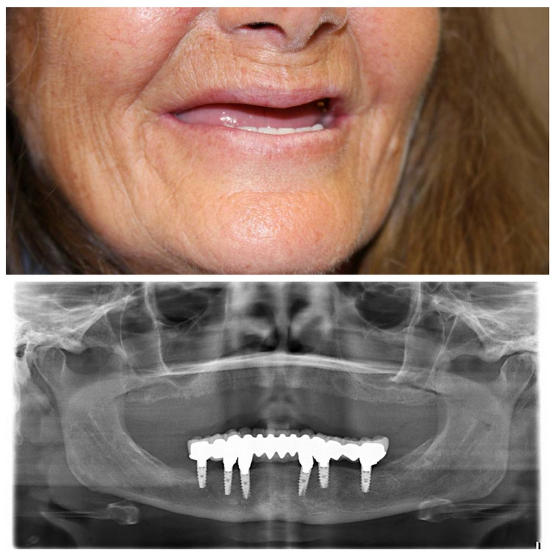 A photo of a patient before receiving a full reconstruction and their X-ray