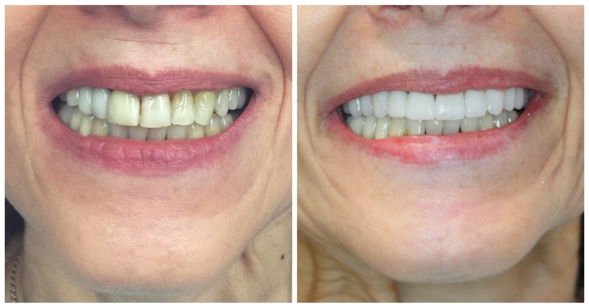 A before-and-after picture of someone who received dental treatment