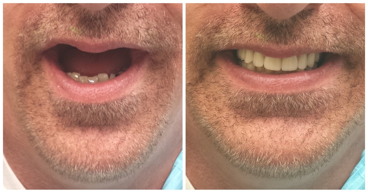 A before-and-after photo of a full-mouth reconstruction