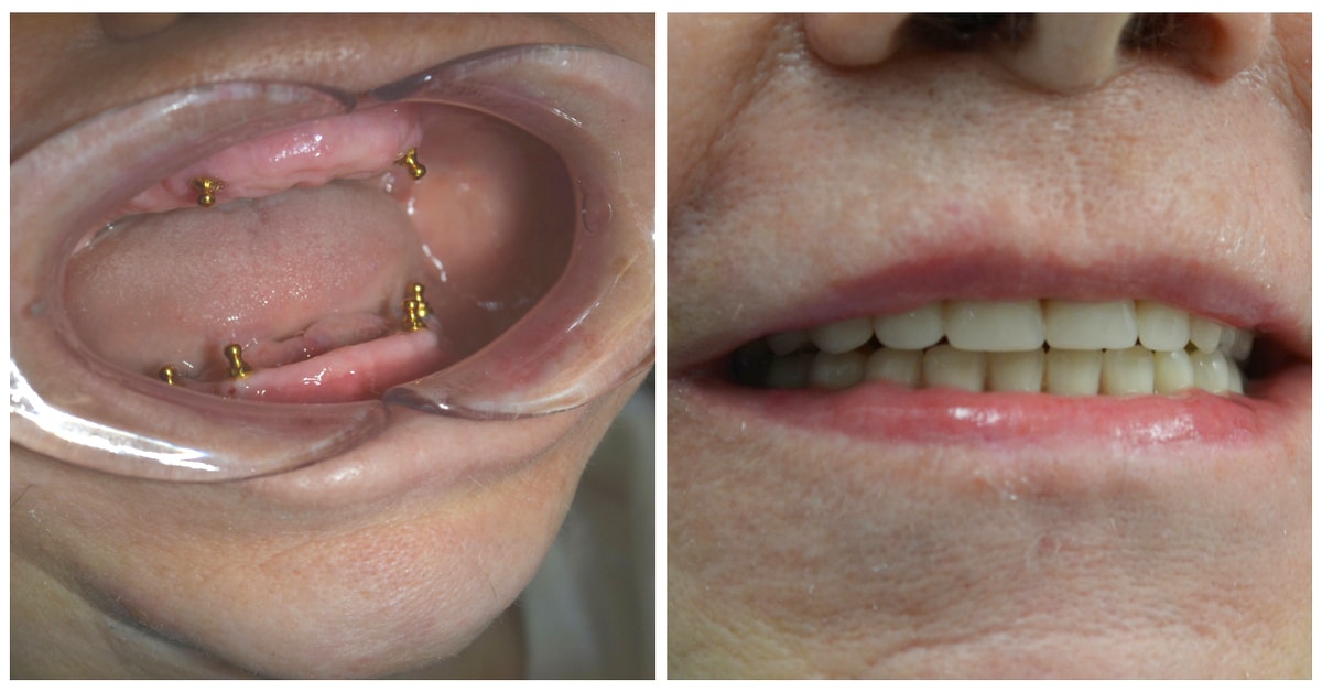 Before and after dental implants