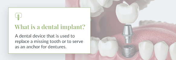 An image of dental implants in New York