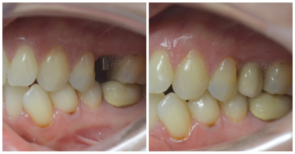 Side-by-side dental implants