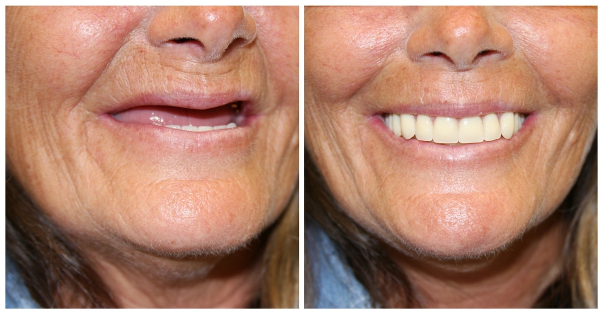 A before-and-after image of someone who received all-on-4 dental implants