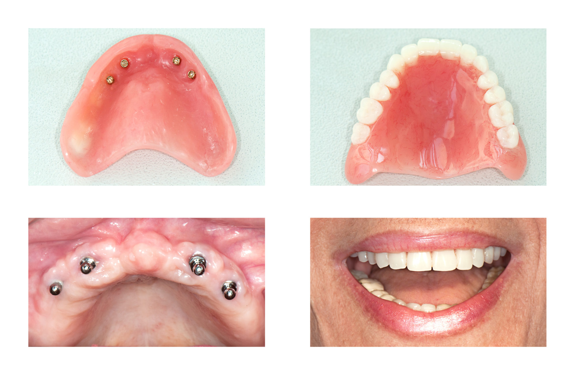 An image showing the process of implant dentures