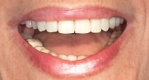 A person with implant dentures smiling