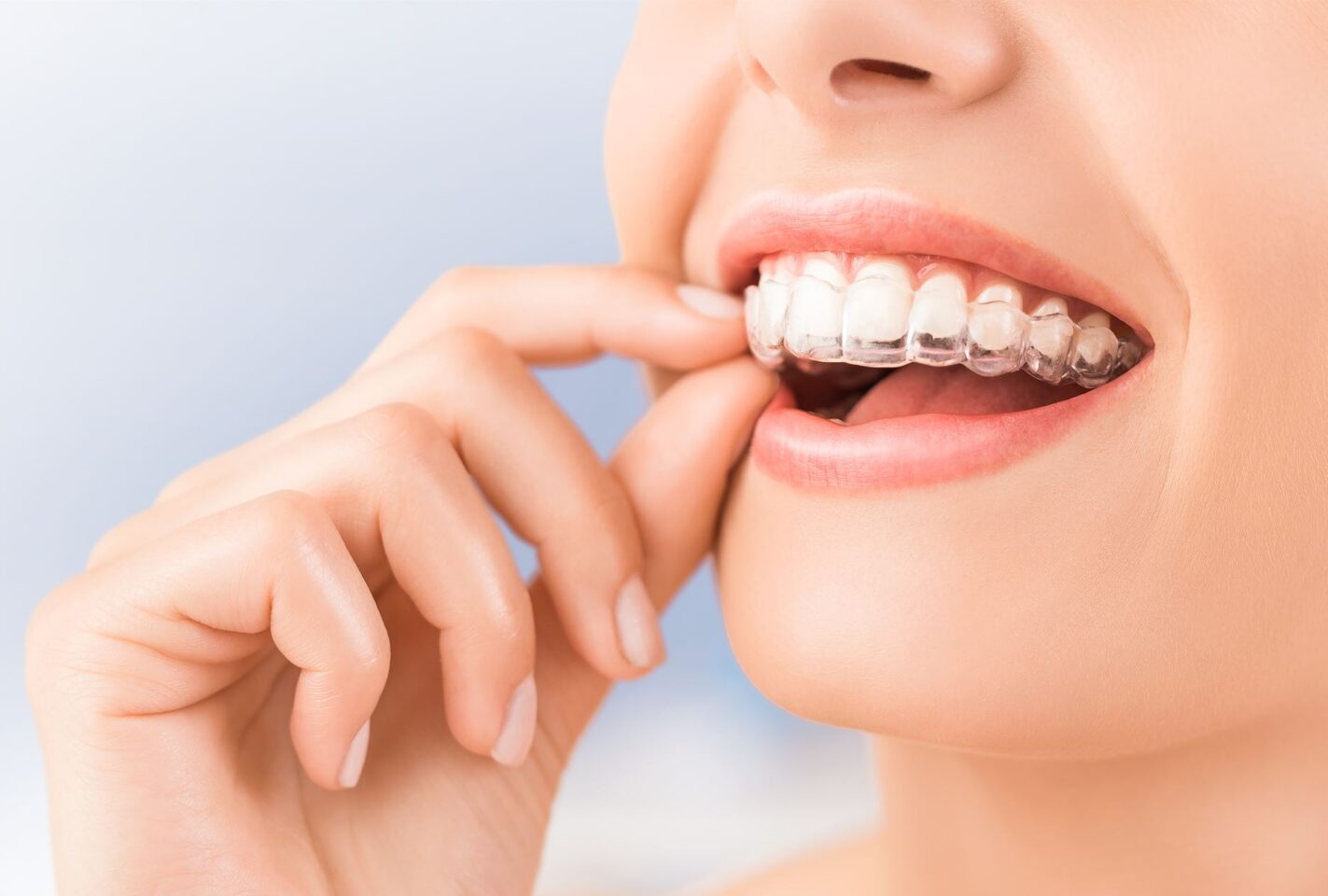 Vivera Retainers & Invisalign Retainer Cost in NYC