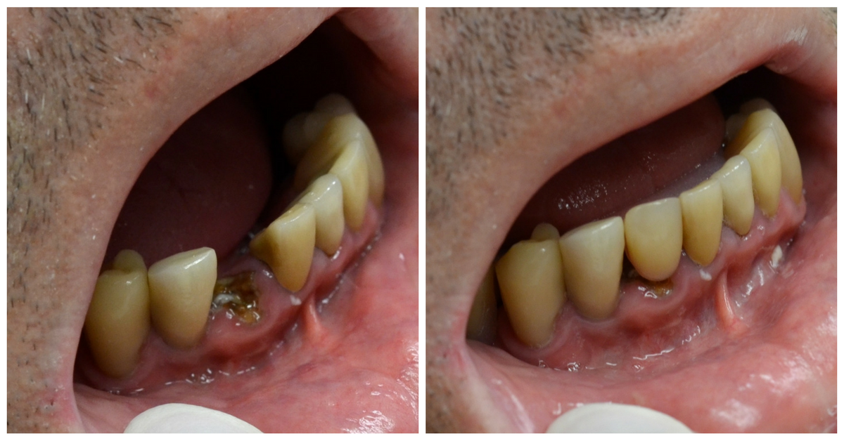 A before-and-after image of someone who received a same-day dental implant