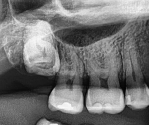 An x-ray of an impacted tooth that requires a wisdom tooth removal in NYC