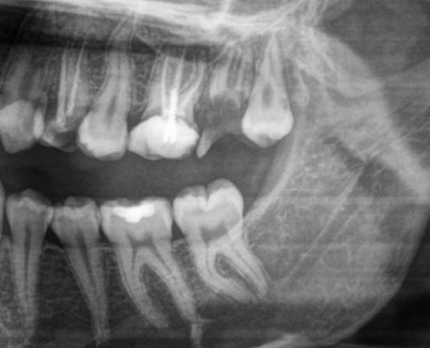 An x-ray of a broken upper tooth