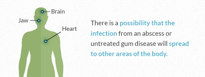 A drawing of a person indicating where oral infections may spread