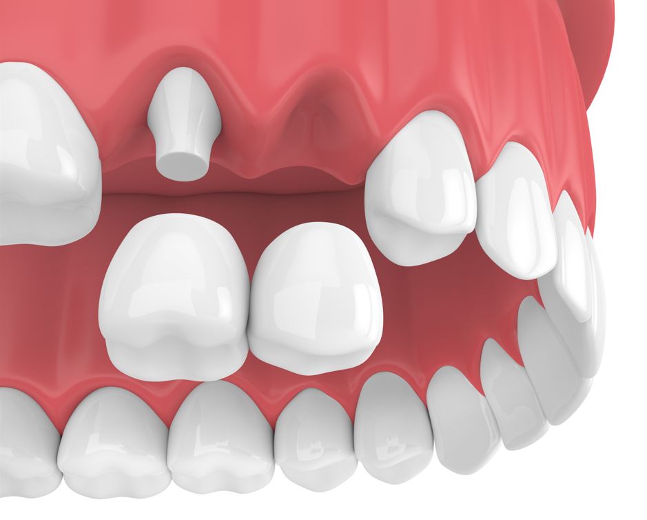 Dental Cantilever bridge