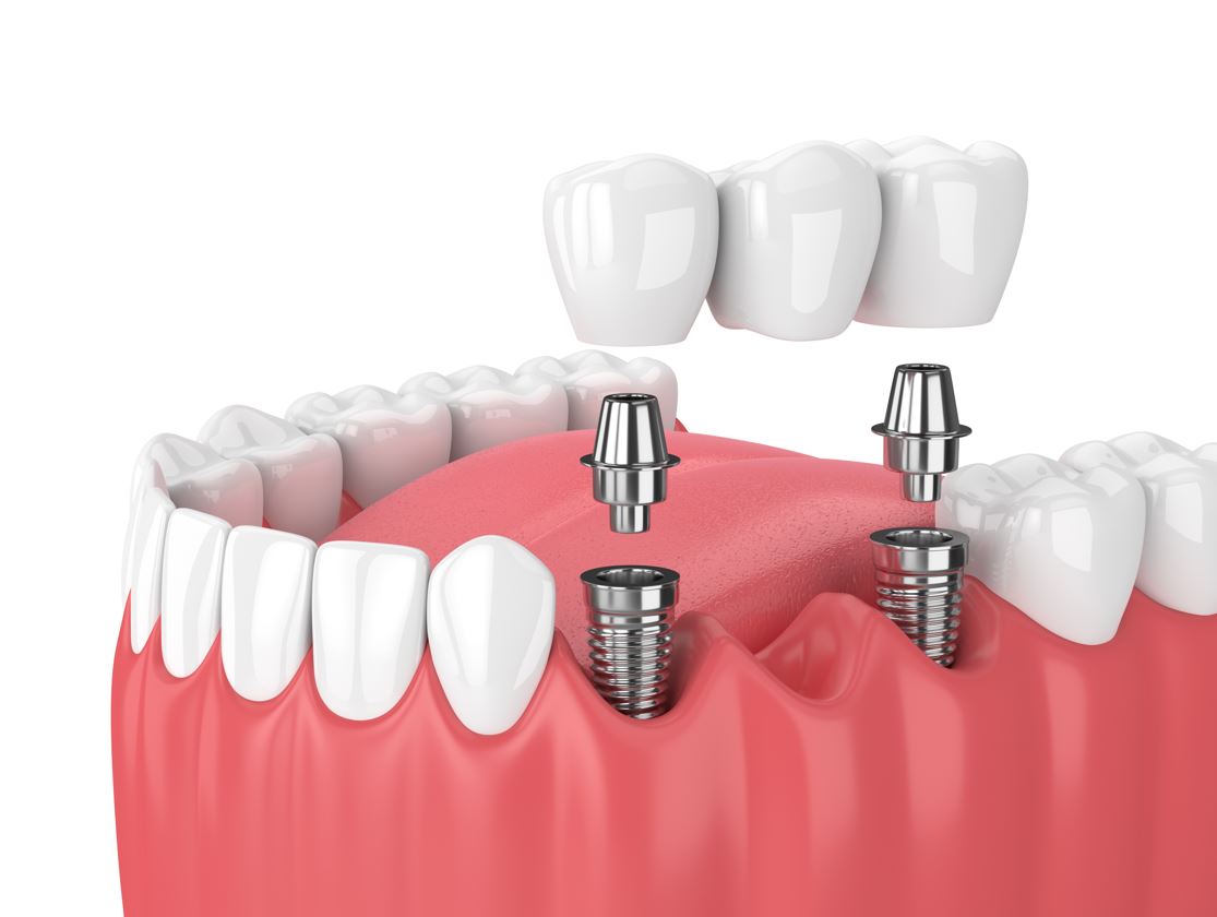 Implant supported dental bridge.