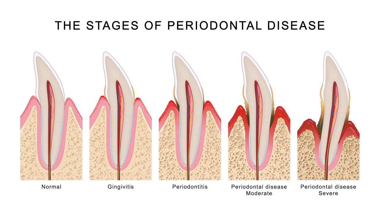 Periodontics: Stages of periodontal gum disease