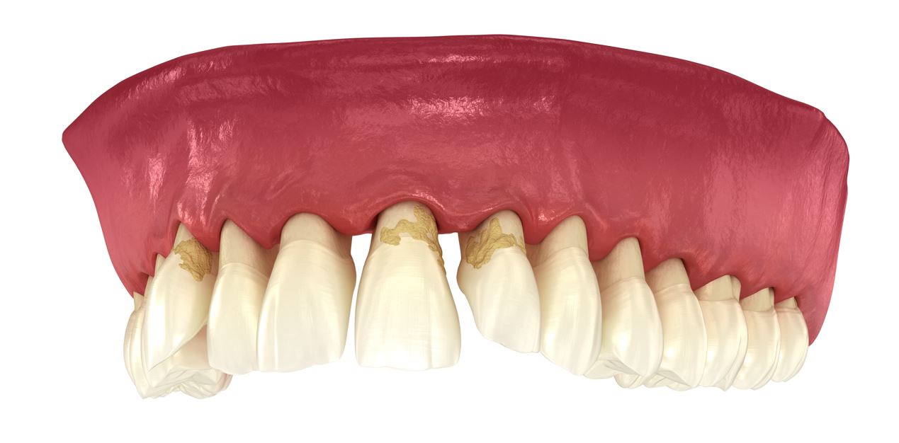 Periodontal Gum Disease