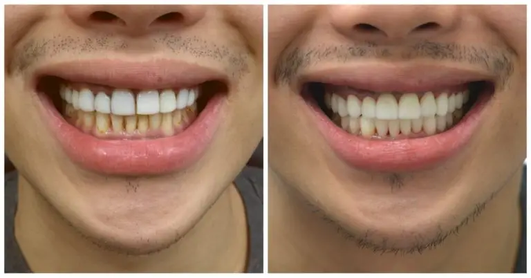 before and after dental pics after someone visited the best dentist in Manhattan