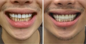 A before-and-after comparison of cosmetic dentistry