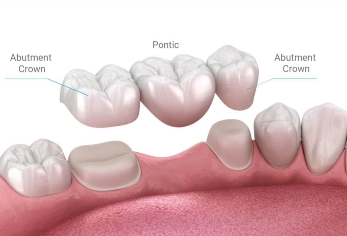 traditional fixed 3-unit all-porcelain dental bridge