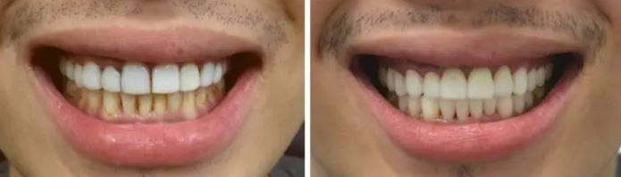 best-Manhattan-dentist-smile-makeover-before-after