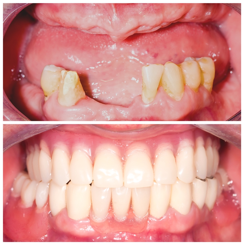 A before-and-after image of someone who received dental work